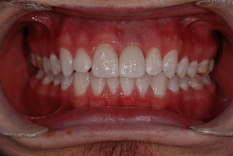 Implant Placement - After