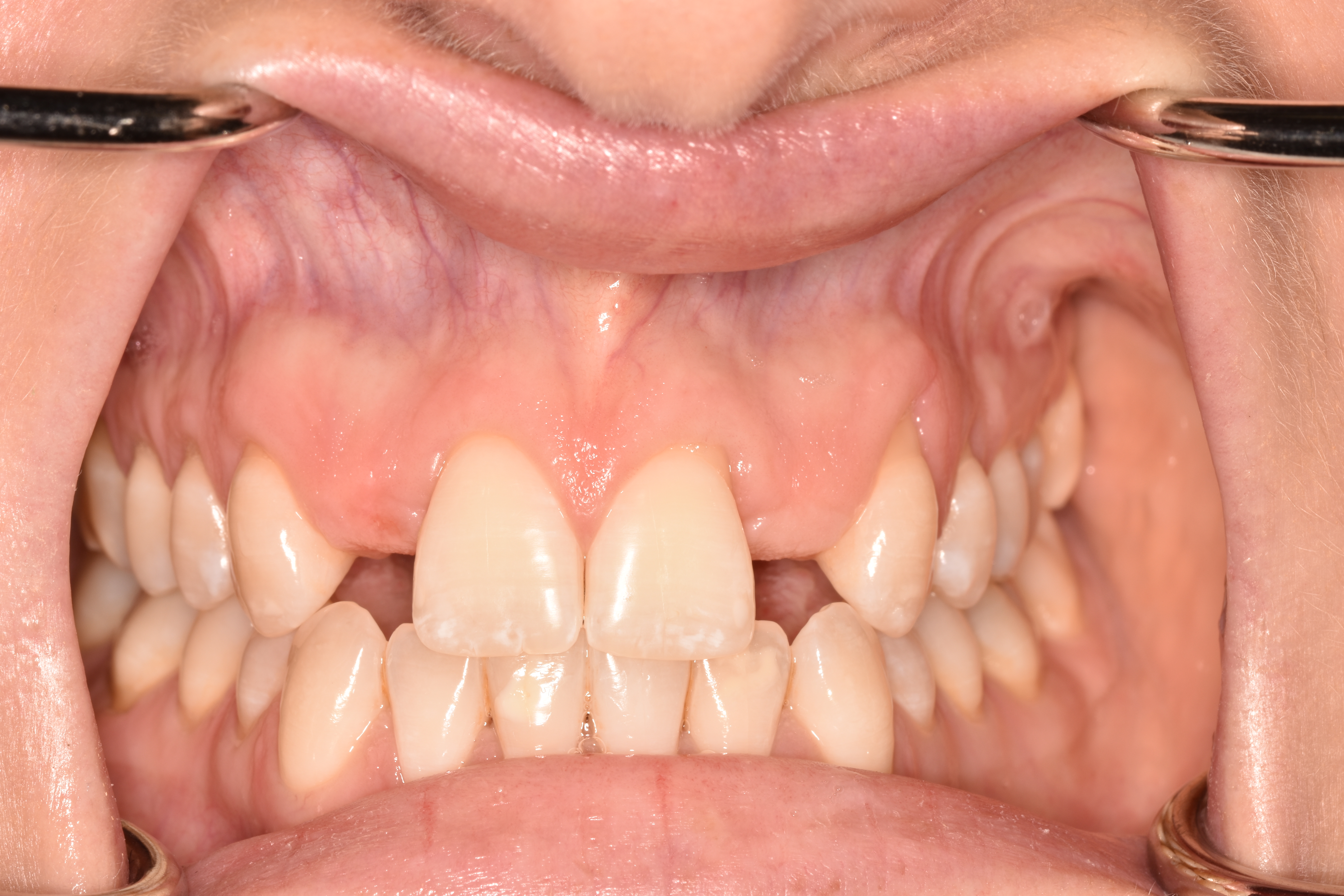 Implant Placement - Before