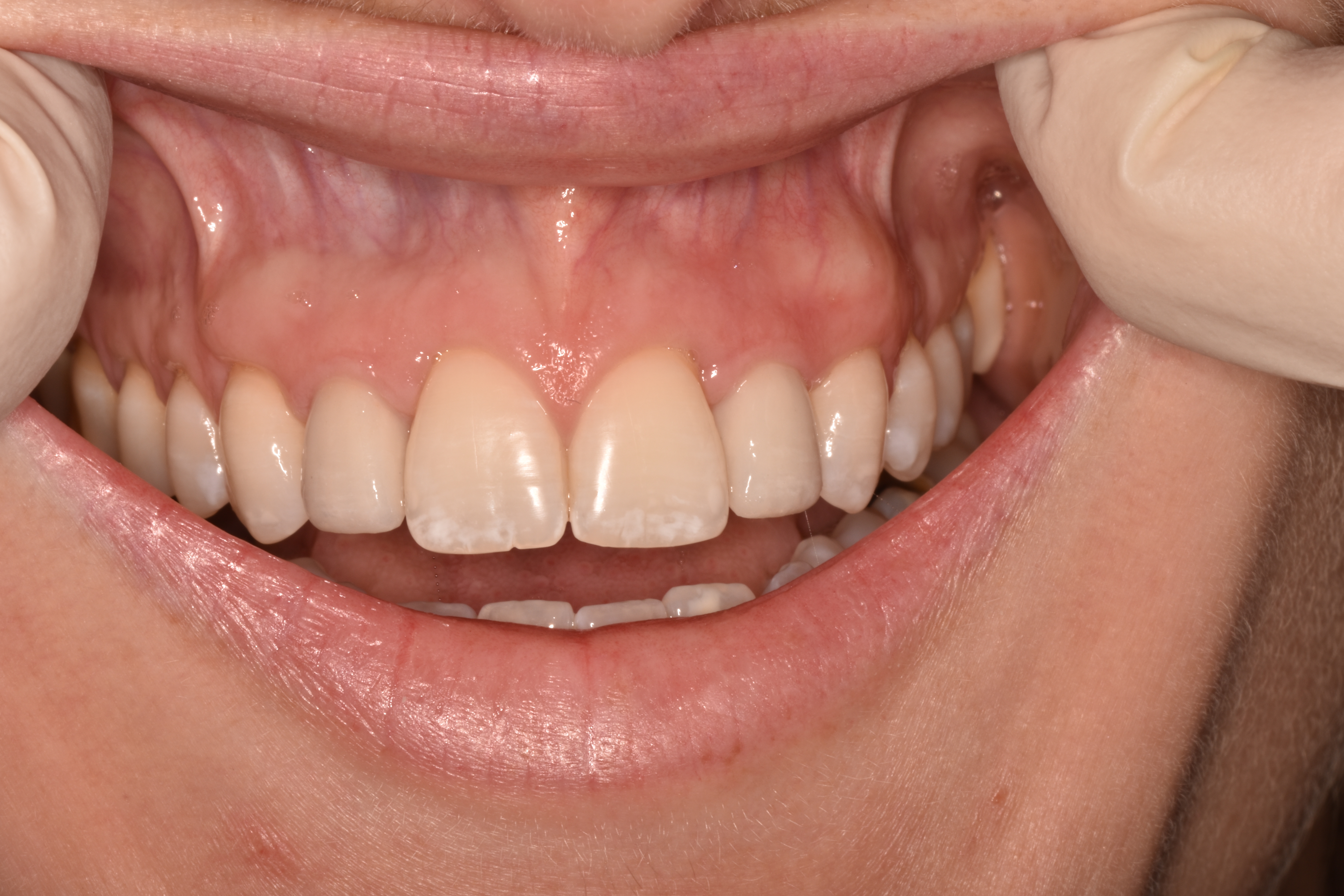 Implant Placement - After